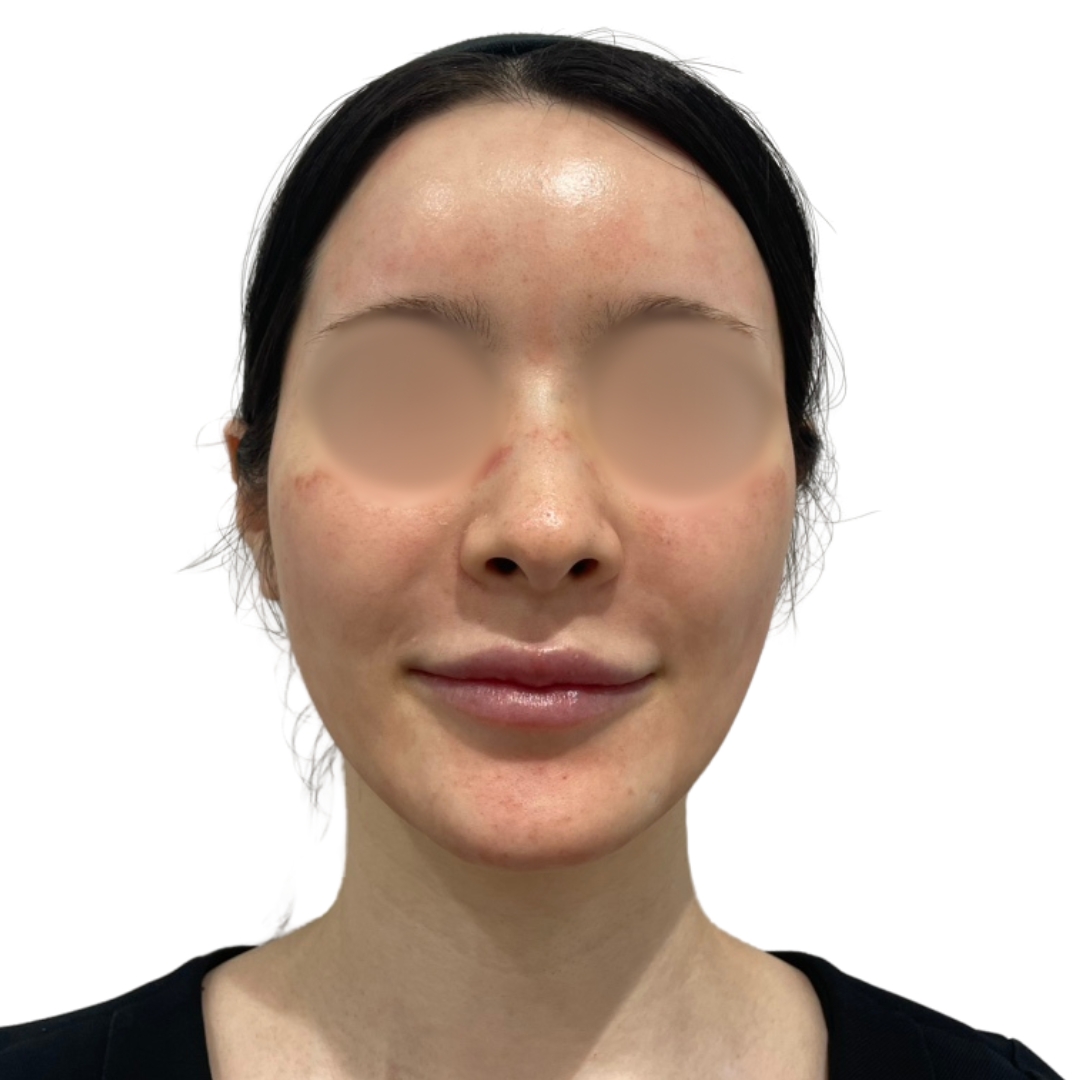 エクソソームフェイシャル